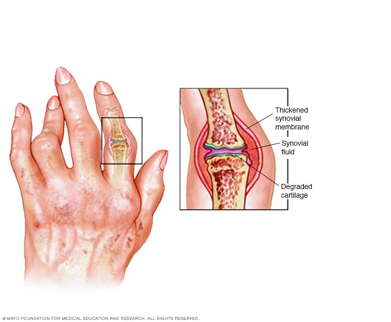 Síntomas artritis reumatoide y fibromialgia